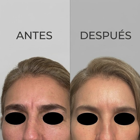 Resultado Toxina Botulínica — Antes y Después